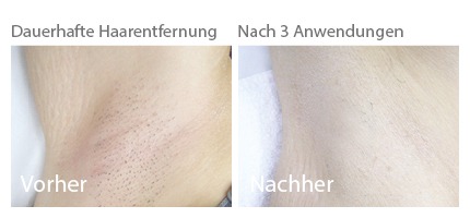 IPL Intimbereich: Haarentfernung bei Mann & Frau