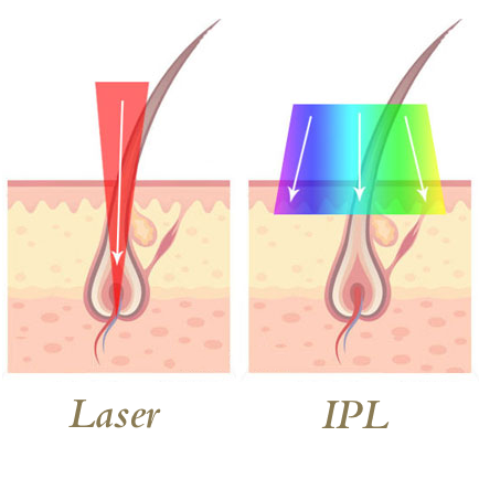 IPL vs. Laser: Welche Methode ist besser?