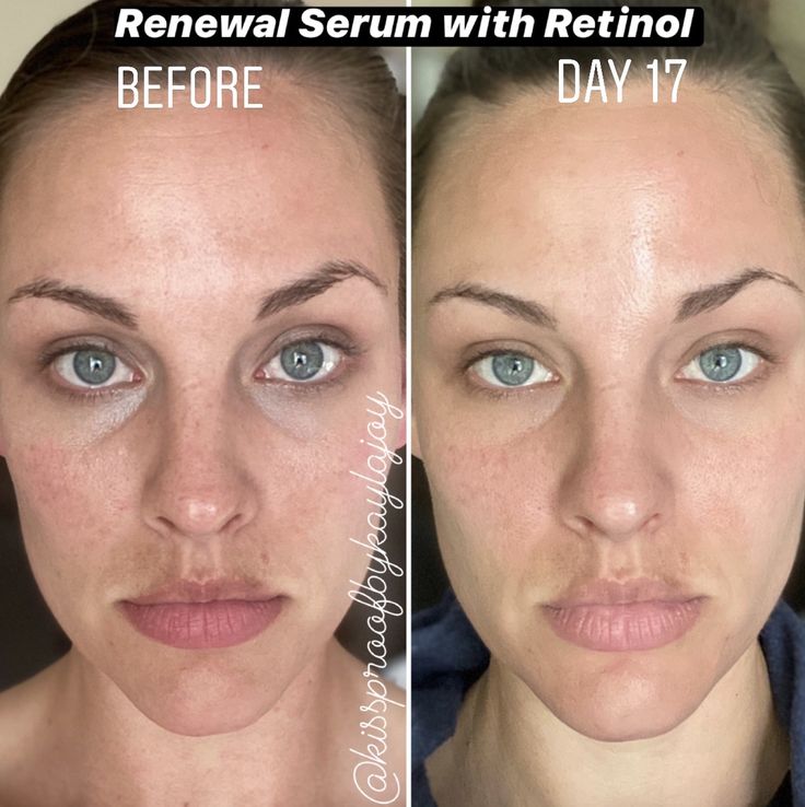 Retinol Serum Wirkung: So gut wirkt Retinol auf der Haut