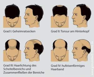 Zu viele Vitamine und Haarausfall: Was ist dran?